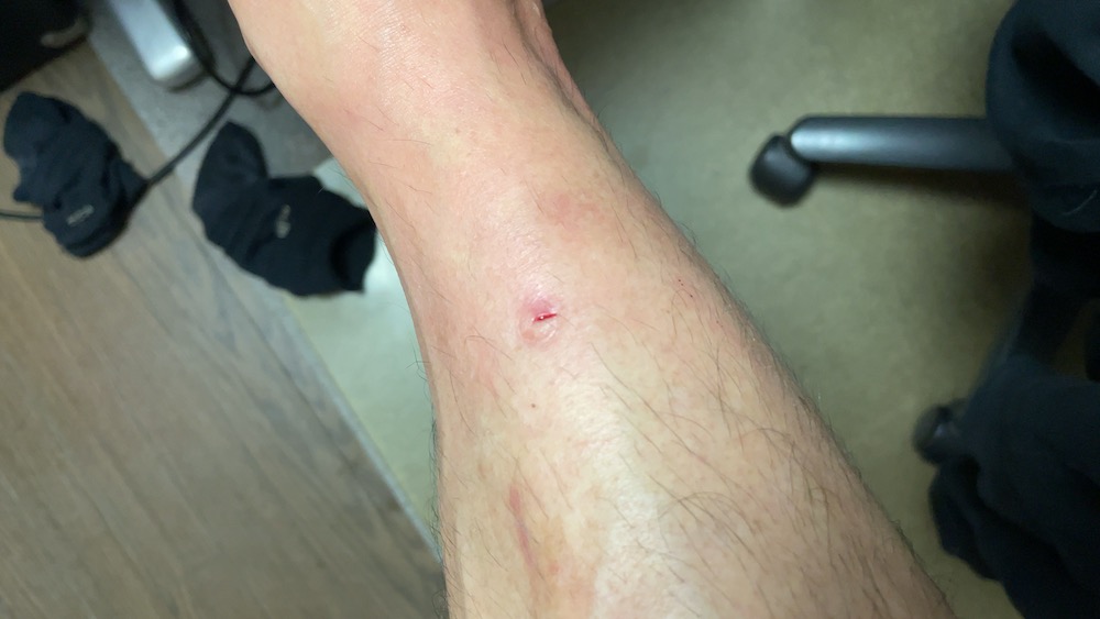 刺されてから1時間ちょい経過した状態