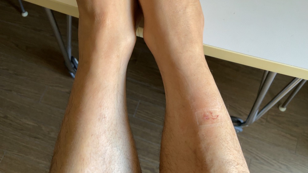 翌朝の刺された足の具合